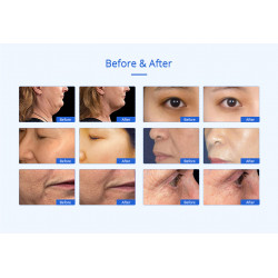 RF Facial Wrinkle Removal Face Lifting Cellulite Reduction Skin Care Device Weight loss Beauty Machine Home Use Elitzia ET22Y2