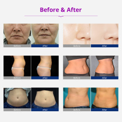 Pro Smart Beauty Device 8 in1 Skin Care Face Body ShapeToning Slimming Device Wrinkle Removing Machine Elitzia ET98D3