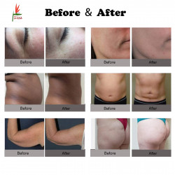 Body Shaper Fat Burning 5 in 1 Skin Lifting Cellulite Reduction Anti-Aging Wrinkle Remover Facial Care Equipment Elitzia ET2021