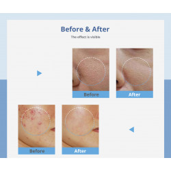 Hydro Facial 3in1  Micodermabrasion  Machine Hydrafacial Face Peeling Cleansing Device Skin  Sprayer Elitzia ET4274