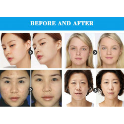 Skin Care Wrinkle Remover Portable Face Lifting Skin Rejuvenation RF Blue Light Spray Beauty Machine Elitzia ETLB294