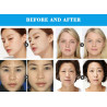 Skin Care Wrinkle Remover Portable Face Lifting Skin Rejuvenation RF Blue Light Spray Beauty Machine Elitzia ETLB294